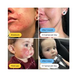 Hypochlorous Acid Spray